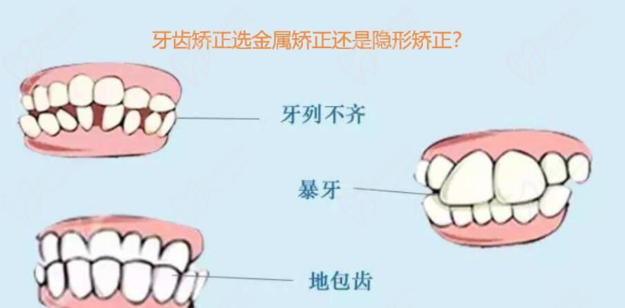 需要牙齒矯正的表現(xiàn)