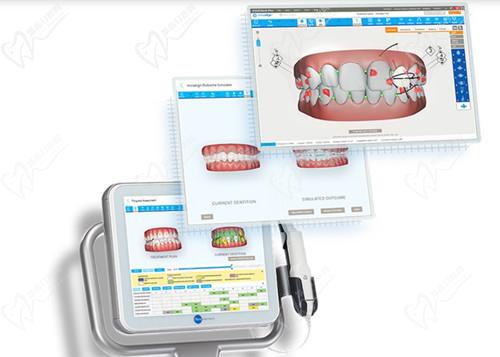長沙美奧口腔3D口掃儀