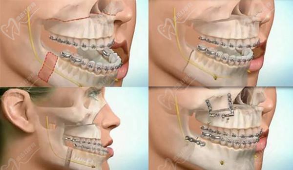 骨性凸嘴涉正頜正畸手術(shù)