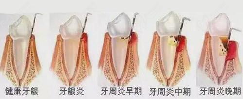 牙周炎