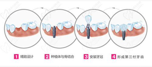 牙齒種植流程