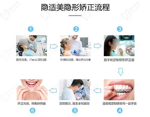 隱適美隱形矯正流程