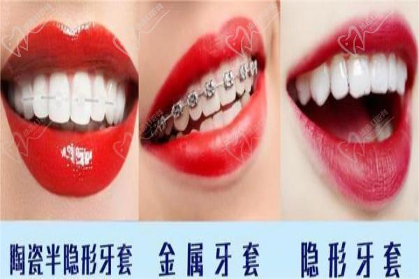 不同類型的牙齒矯正器