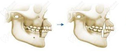 正頜正畸聯(lián)合治療手術