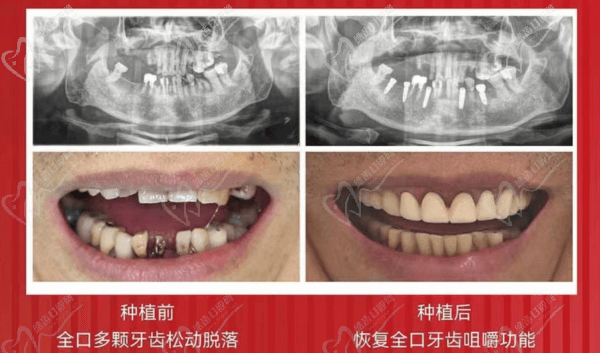 種植前后對比