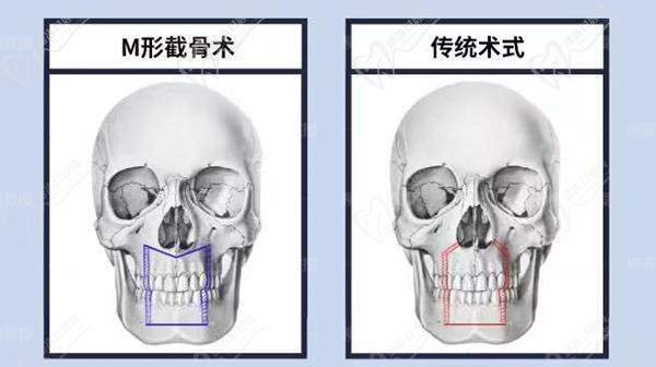 正頜直術(shù)比正頜手術(shù)會(huì)影響手術(shù)成效嗎