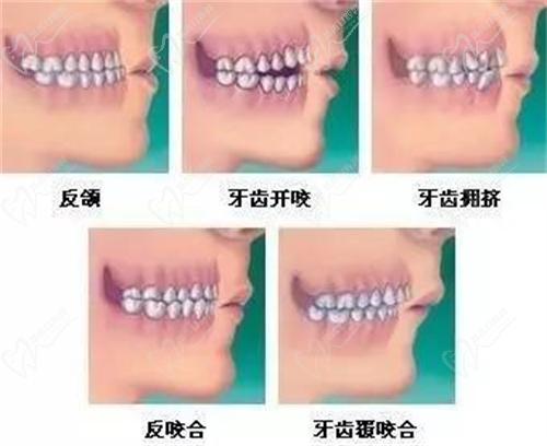 兒童早期矯正