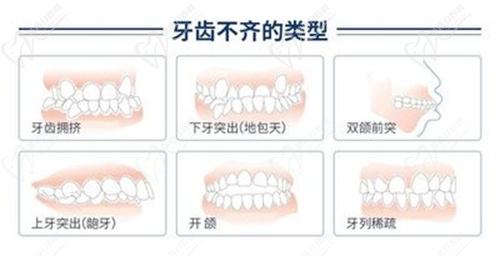 兒童早期矯正