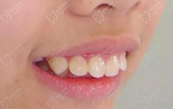 兒童牙齒早期矯正