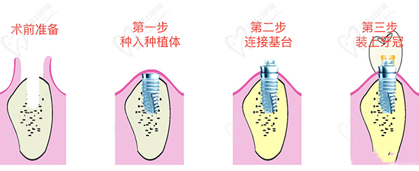 種植牙過(guò)程