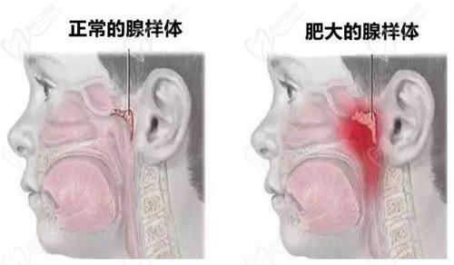 口呼吸