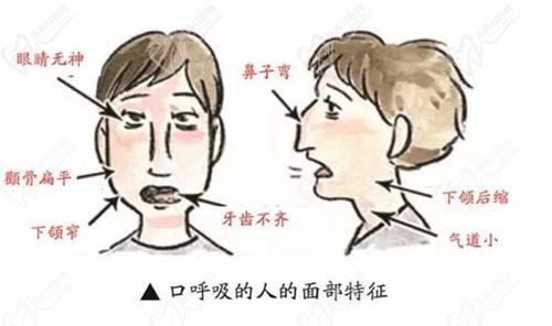 口呼吸