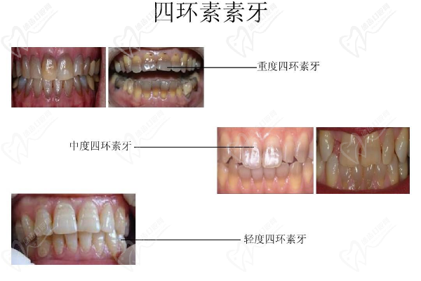 四環(huán)素牙做全瓷冠還是瓷貼面好