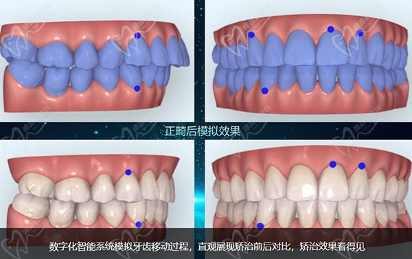 德倫口腔矯正牙齒怎么樣正畸模擬