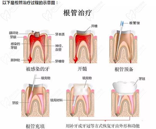 根管治療