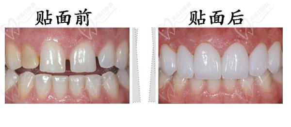 樹脂貼面貼面前后