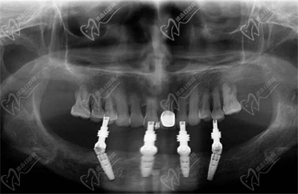 All-on-4種植牙