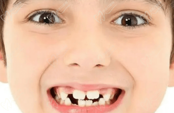 兒牙