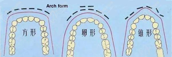 擴(kuò)牙弓一般擴(kuò)多少天