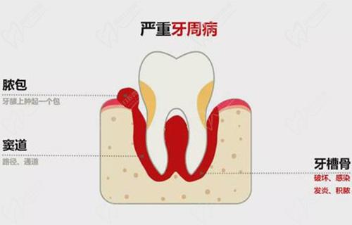 牙齒瘺管長期不治療有什么危害