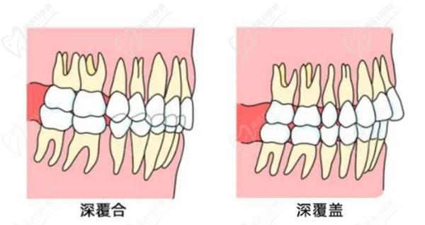 上牙包住下牙矯正后臉型會變嗎