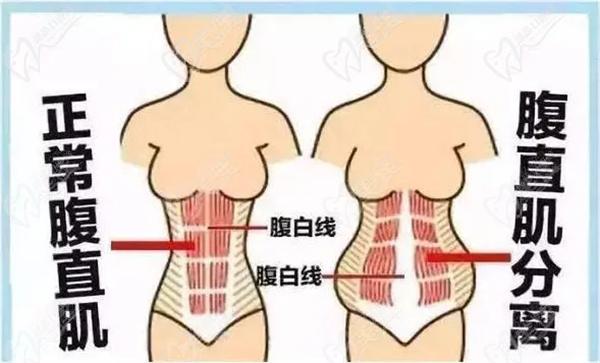 腹壁整形