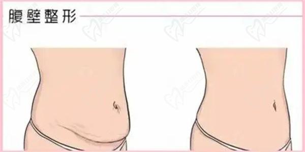腹部整形手術(shù)圖片