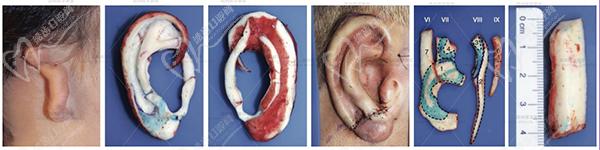 康春雨擴張單瓣兩次法外耳再造技術(shù)流程
