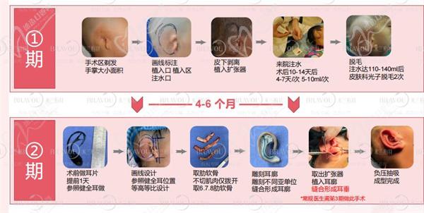 康春雨耳再造手術(shù)過程