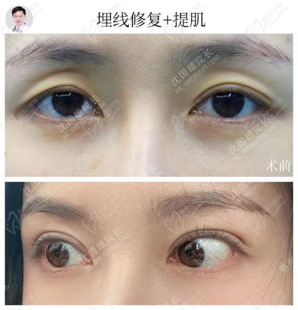 沈國(guó)雄雙眼皮手術(shù)圖片