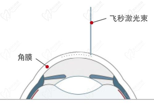 王曉瑛醫(yī)生做近視手術技術高超