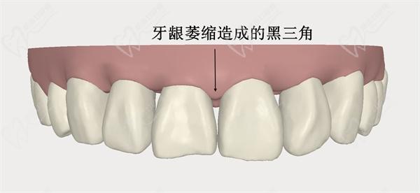 牙齒三角區(qū)