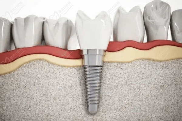 種植牙與傳統(tǒng)鑲牙哪個(gè)好？