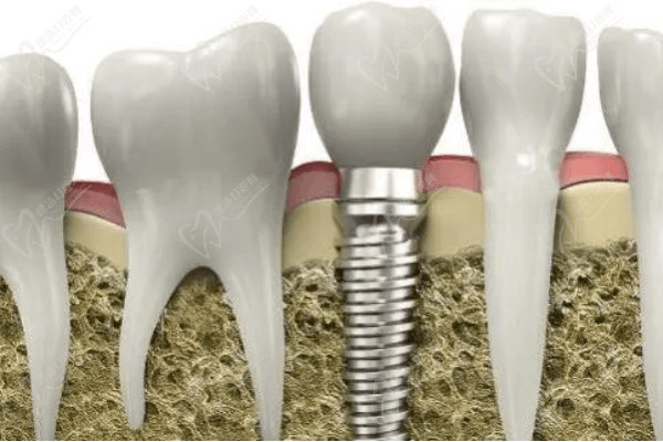 種植牙與傳統(tǒng)鑲牙哪個(gè)好？