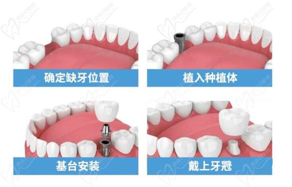 微創(chuàng)種植牙有什么優(yōu)點