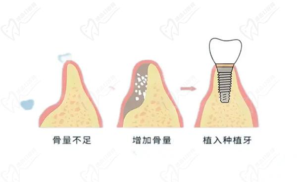 韓國(guó)易普萊種植牙怎么樣