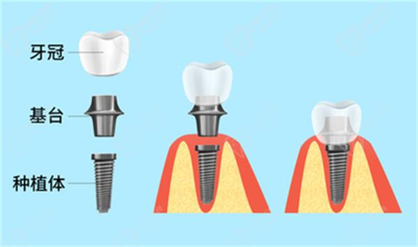 牙齒種植修復(fù)