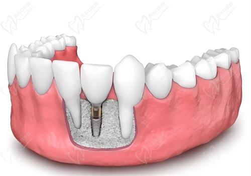 陶瓷種植體的優(yōu)點