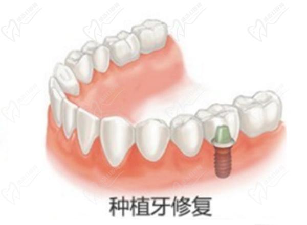 種植牙韓國和德國應(yīng)該怎么區(qū)別