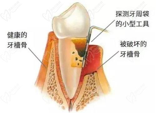 天津口腔醫(yī)院牙周炎刮治費用