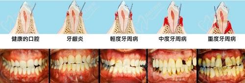 天津口腔醫(yī)院牙周炎刮治費用