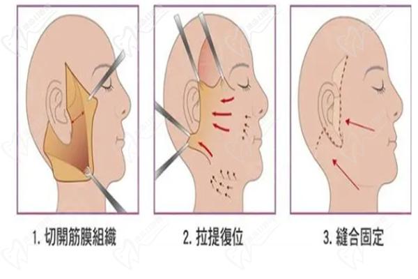 倪鋒拉皮手術(shù)特點(diǎn)