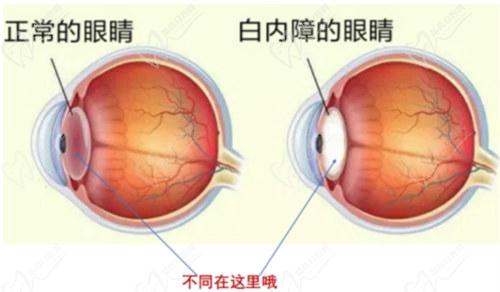 白內(nèi)障多焦點人工晶體的優(yōu)勢