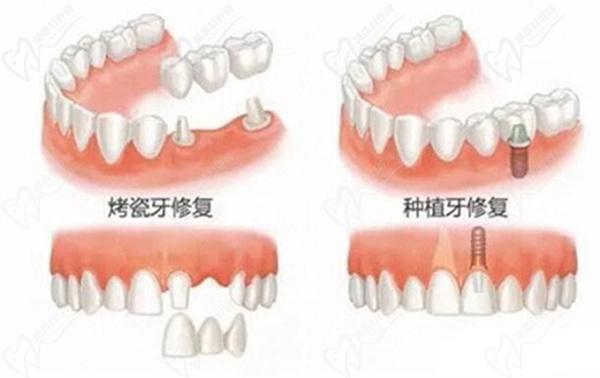 牙齒種植