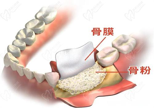 為什么種植牙骨粉骨膜價格較高?