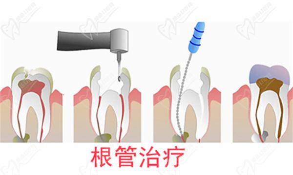 根管治療