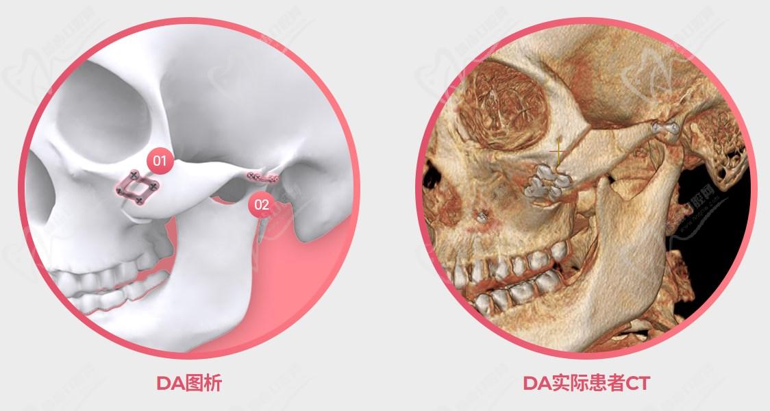 韓國da整形醫(yī)院做輪廓怎么樣