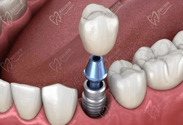 沈陽牙元素口腔種植牙做得好