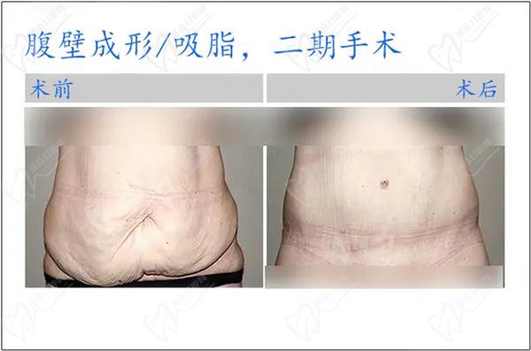 肚皮松弛下垂整形