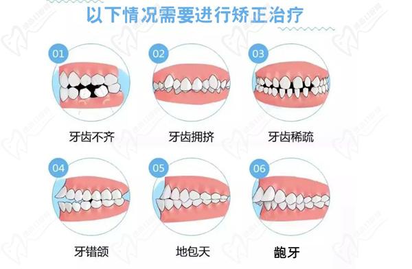 深圳齙牙矯正牙齒多少錢(qián)